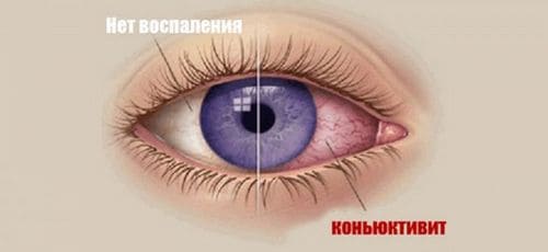 Вирусный конъюнктивит